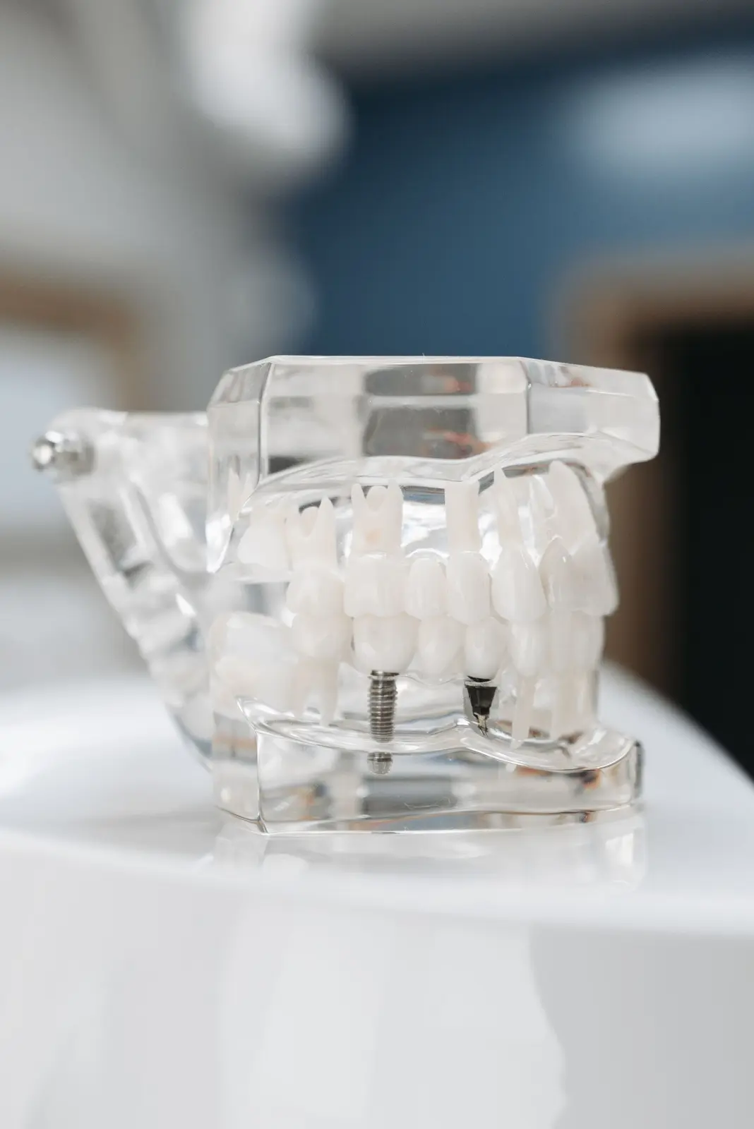 Peri-implantitis: İmplant Çevresi Dokuların İltihabi Hastalığı